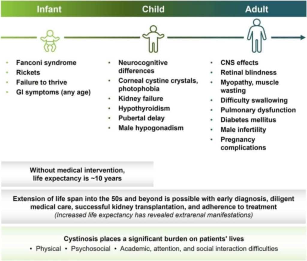 First figure included in the above article in this month's Kidney International Reports is on a white background with green shading denoting symptoms in infants, children and adults with Nephropathic Cystinosis. The following information reads: Infant • Fanconi Syndrome • Rickets • Failure to thrive • GI symptoms (can begin at any age); Child • Neurocognitive differences • Corneal cystine crystals, photophobia • Kidney failure • Hypothyroidism • Pubertal delay • Male hypogonadism; Adult • CNS (Central Nervous System) effects •Retinal blindness •Myopathy, muscle wasting •Difficulty swallowing •Pulmonary dysfunction •Diabetes mellitus •Male infertility •Pregnancy complications; Without medical intervention, life expectancy is less than 10 years; Extension of life span into the 50s and beyond is possible with early diagnosis, diligent medical care, successful kidney transplantation, and adherence to treatment; Increased life expectancy has revealed extrarenal manifestations; Cystinosis places a significant burden on patients' lives • Physical • Psychosocial • Academic, attention, and social interaction difficulties